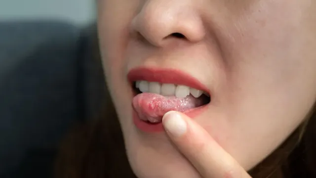Пятна на языке и щеках могут говорить о раке рта