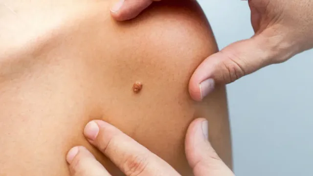 Врач назвал виды папиллом, которые могут перерасти в рак