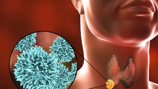 Эндокринолог Губкина назвала первый симптом рака щитовидки, ставящий в тупик