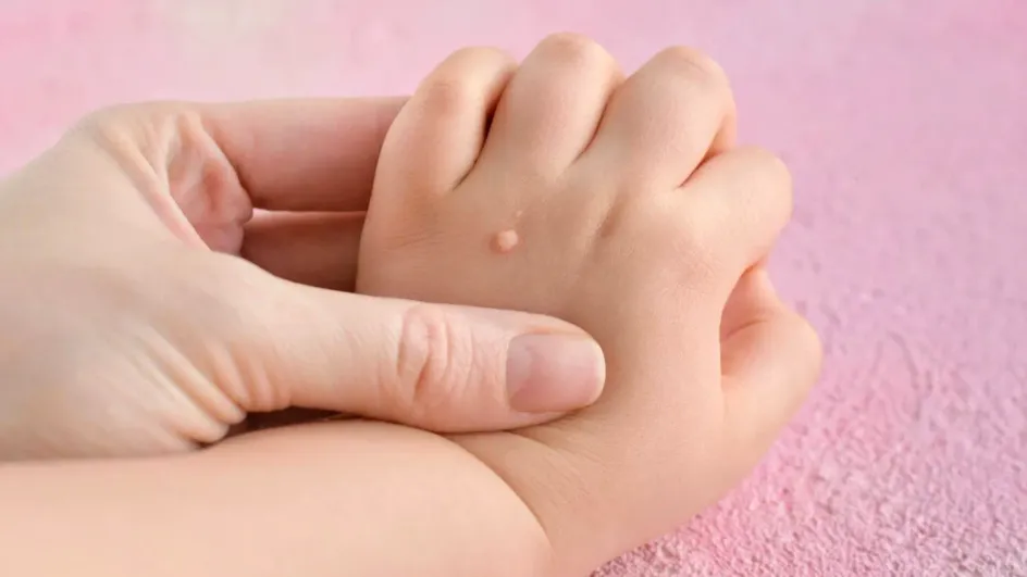 Названы народные средства, которые помогут избавиться от бородавок у детей