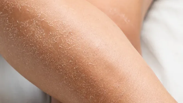 Врач рассказала, о чем может сигнализировать сухость кожи