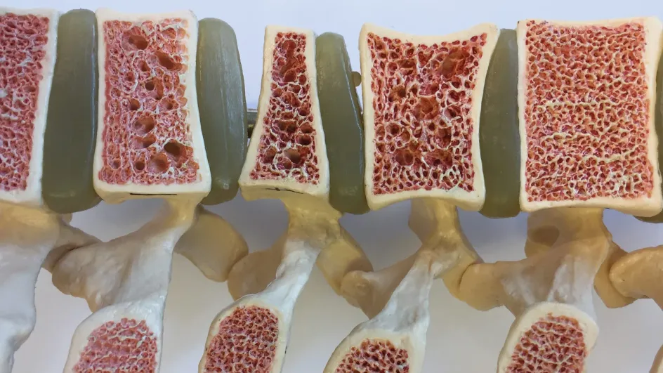 Ученые нашли способ обратить вспять развитие остеопороза