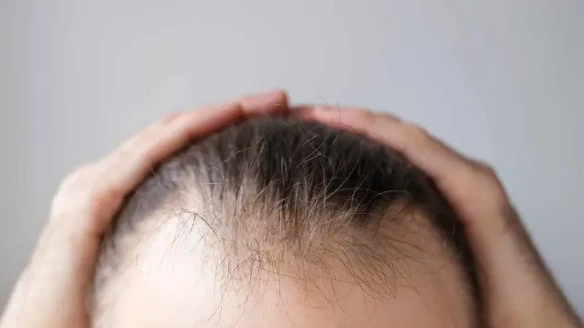 Врач назвала рабочие альтернативы пересадке волос