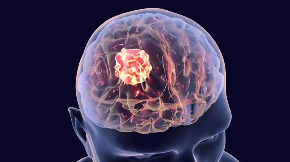 Названы основные симптомы рака мозга на ранних стадиях