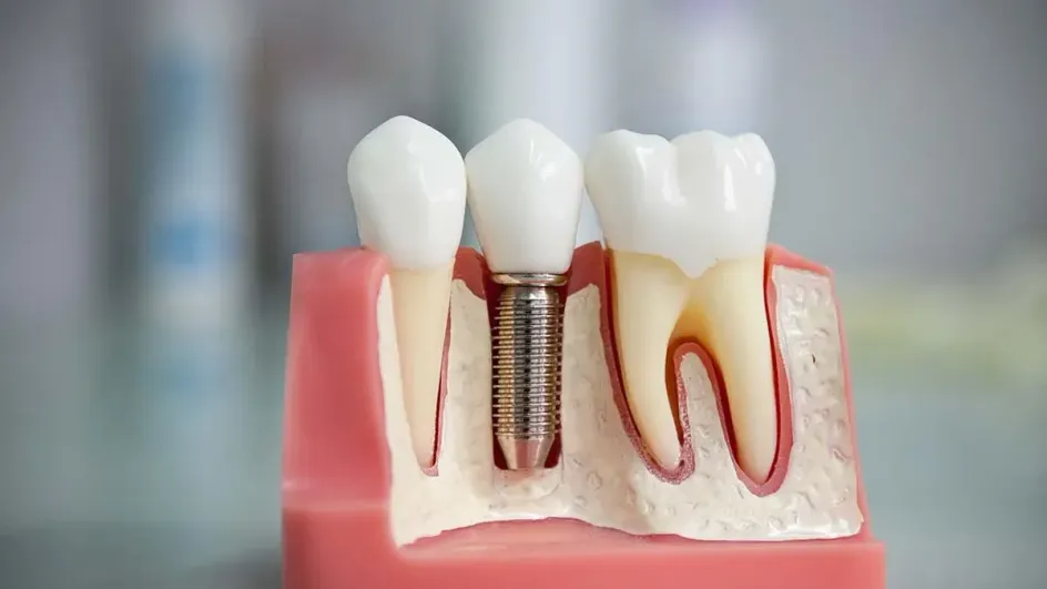 Российские врачи нашли альтернативу имплантации зубов