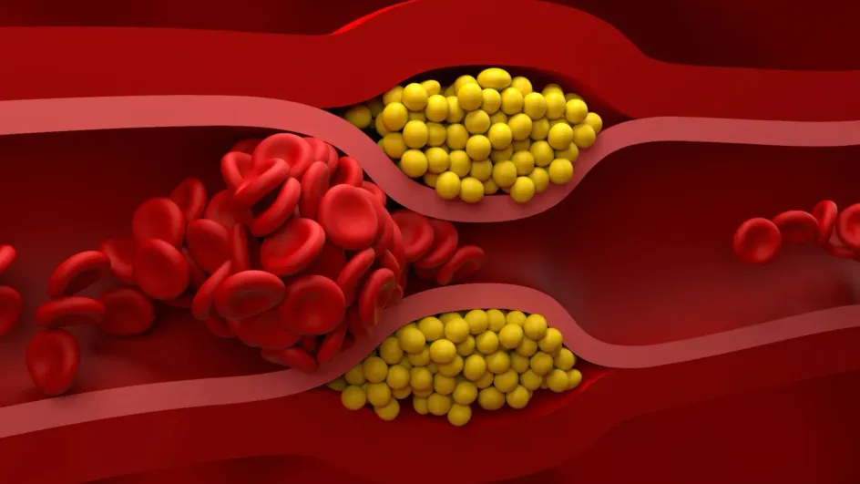Врач назвал причины повышенного холестерина у худых людей
