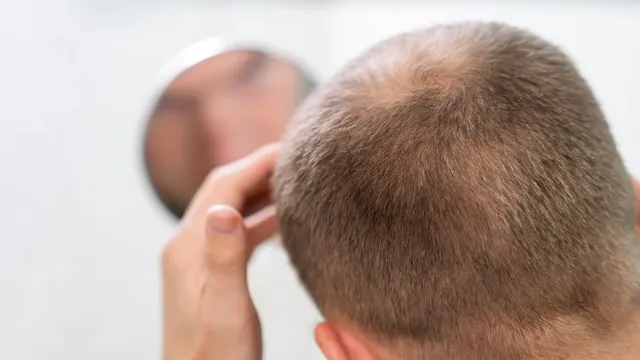 Россиянам назвали необычный способ борьбы с облысением