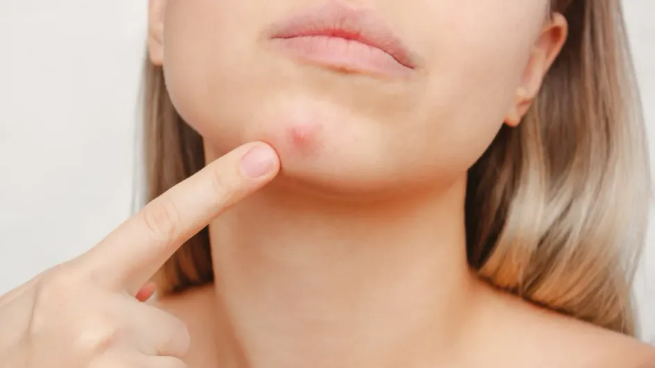 Россиянам рассказали, когда прыщи сигнализируют и проблемах со здоровьем