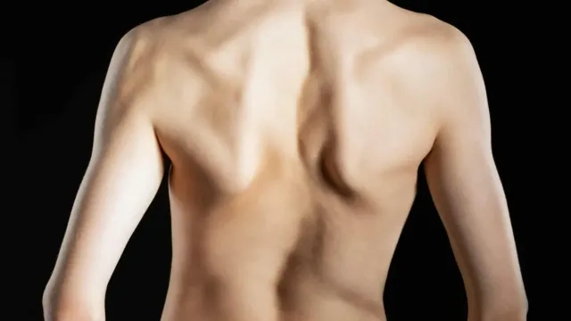 Названа частая причина возникновения сколиоза у подростков