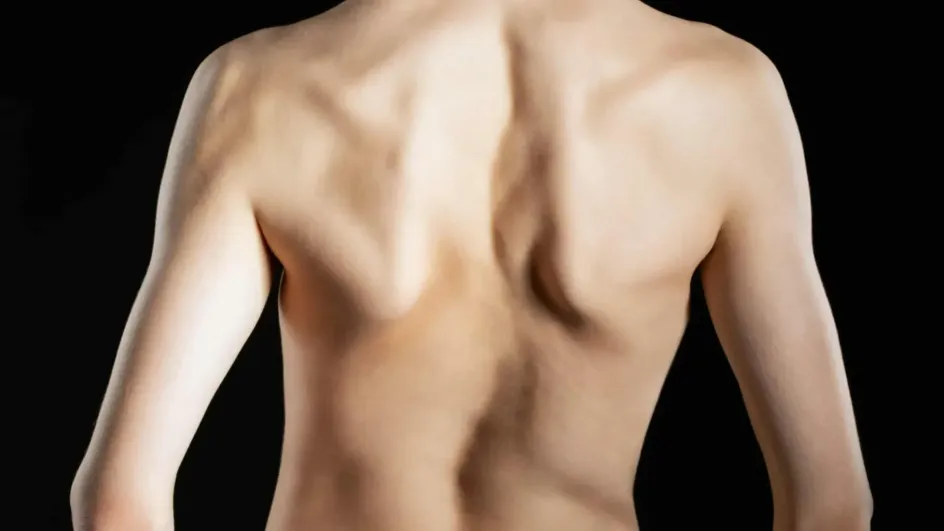 Названа частая причина возникновения сколиоза у подростков