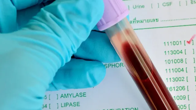 Врач назвал обязательный анализ крови для мужчин старше 50 лет