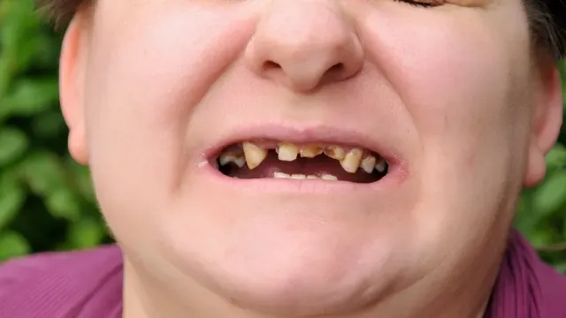 ОСН: Врач-стоматолог назвала 5 «летних» продуктов, которые губят зубы