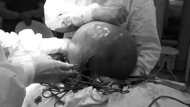 "Толк": Гинекологи удалили пациентке кисту размером с футбольный мяч