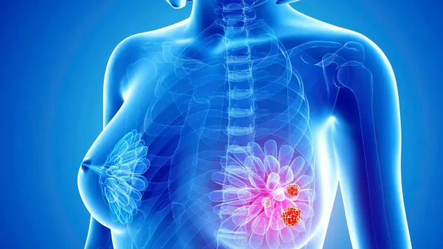 Врач назвала причину, по которой развивается самый опасный рак груди