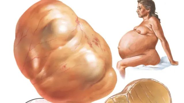 Хирурги удалили женщине 50-килограммовую кисту яичника