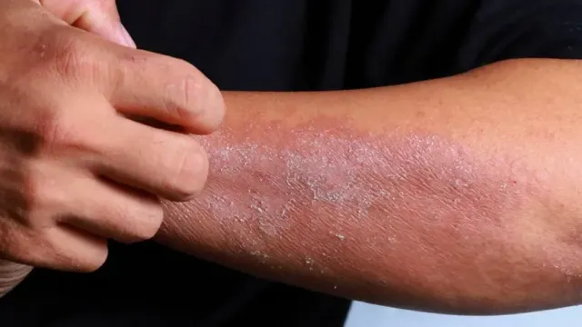 В России разработали гель для лечения рака кожи и псориаза