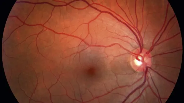 В России создали метод диагностики тромбоза вен сетчатки глаза по слезам