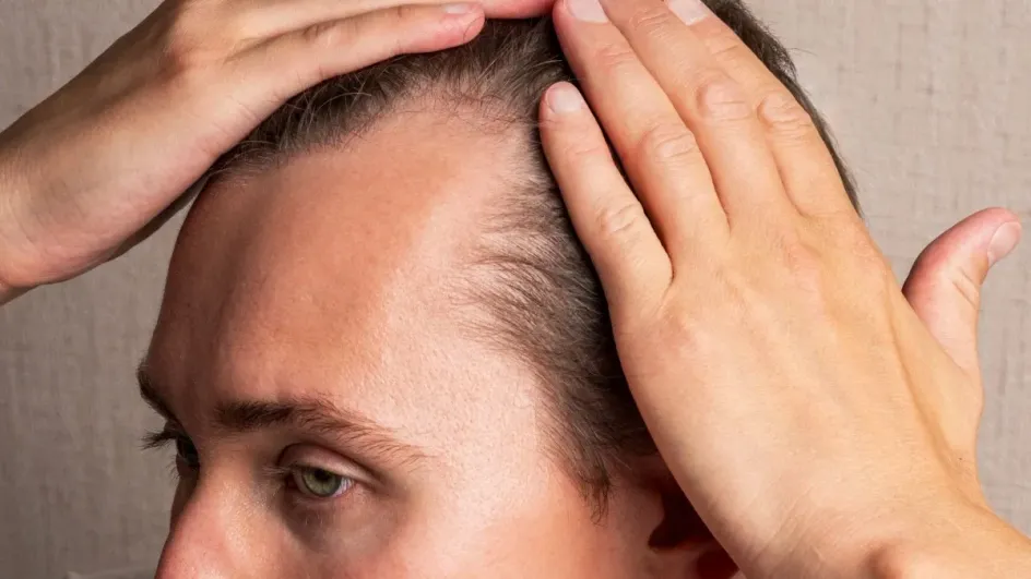 Российские ученые научились прогнозировать облысение