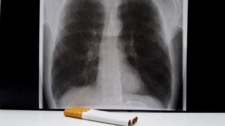 Показывает ли флюорография курение