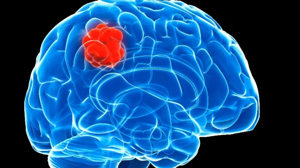 Российские ученые нашли способ уничтожения быстрорастущей опухоли в головном мозге