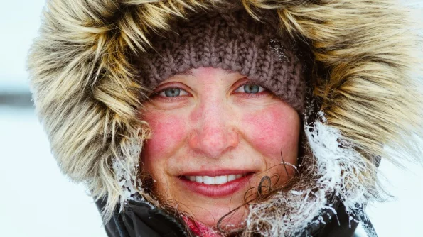 Аллергия на холод: почему надо защищать кожу от мороза