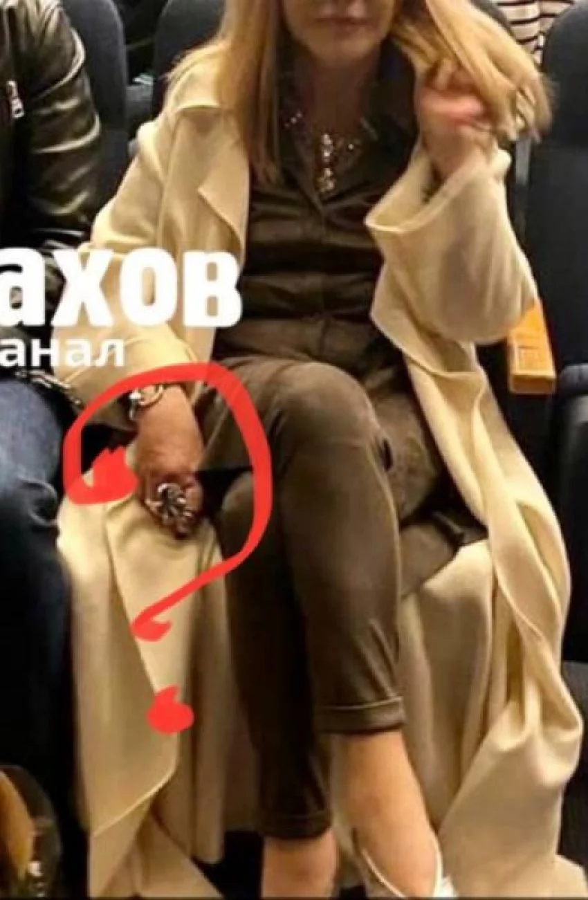 Поклонники Аллы Пугачевой рассмотрели страшную опухоль на руке певицы
