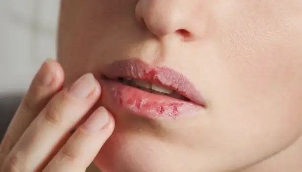 Дерматолог рассказала, что сухость губ может быть симптомом аутоиммунных заболеваний