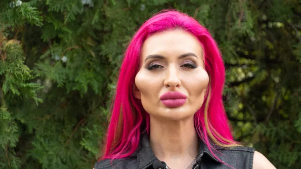 Украинка Анастасия Покрищук с аномально большими щеками пожаловалась на здоровье